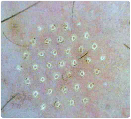 pelle al microscopio dopo il ringiovanimento frazionato