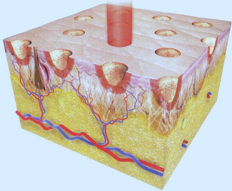 termolisi laser frazionata