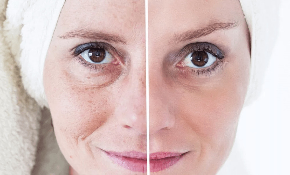 ringiovanimento facciale laser